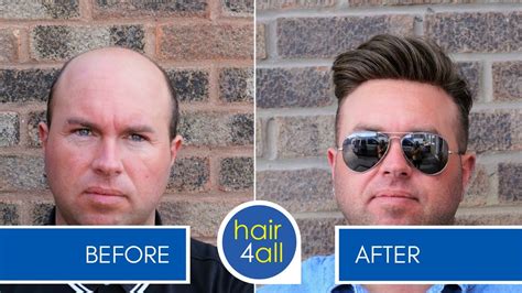 Before & After a Non-Surgical Hair Replacement System for Men (Hair Loss/Baldness) - YouTube