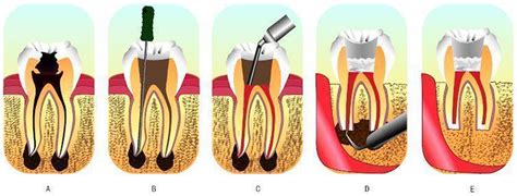 Root Canal - Procedure, Causes, and Root Canal Recovery