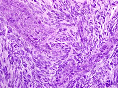 Pathology Outlines - Synovial sarcoma