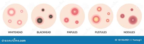 Types of Acne Illustration. Whitehead,blackhead,Papules and Pustules, and Nodules on Skin ...