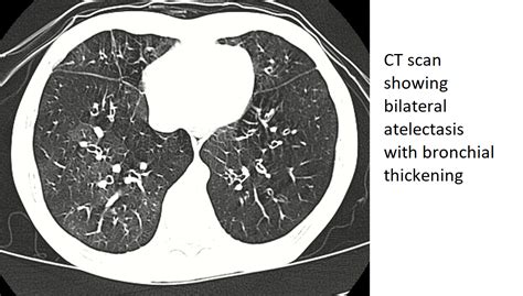 Adult bronchiolitis CT - wikidoc