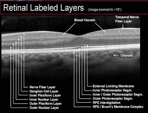 OPTICAL COHERENCE TOMOGRAPHY (OCT) - Toronto Eye Clinic