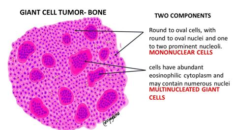 GIANT CELL TUMOR- BONE | Pathology Made Simple