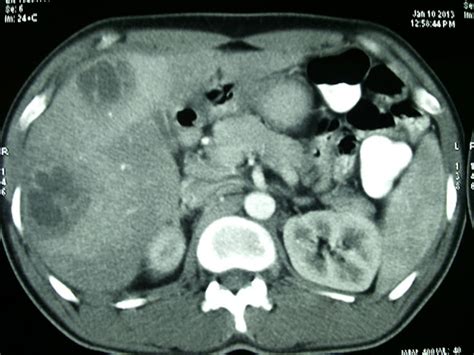 RADIOLOGY IMAGE SPOTTERS: Pyogenic liver abscess