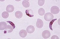 Plasmodium falciparum, blood smear with more gametocytes * – Instruments Direct