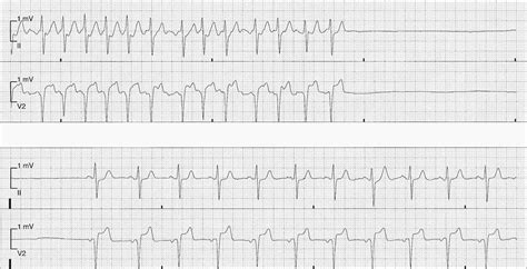 ECG of the Week: ECG of the Week - 31st December - Interpretation