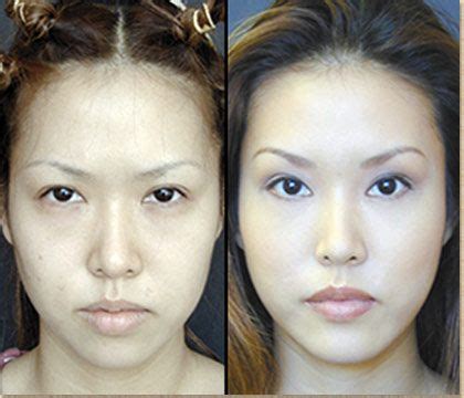 Asian Blepharoplasty - Before and After | Cosmetic surgery, Eyelid surgery, Plastic surgery