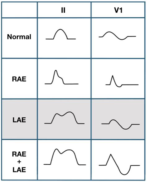 Left Atrial Enlargement • LITFL Medical Blog • ECG Library Basics