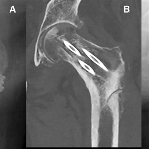 Postoperative X-ray of a femoral neck fracture treated with cannulated... | Download Scientific ...