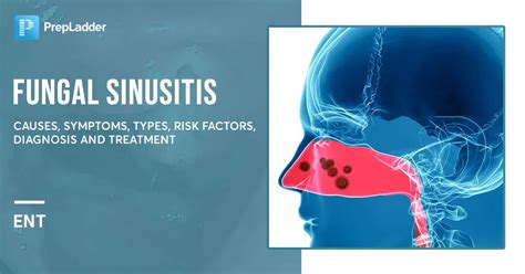 Fungal Sinusitis: Causes, Symptoms, Types, Risk Factors, Diagnosis and ...