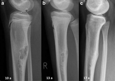 Bottumor - Bone tumor - abcdef.wiki