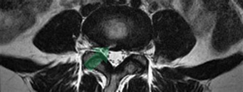 Annular Fissure | MRI findings with a Chronic Low Back Pain Patient ...