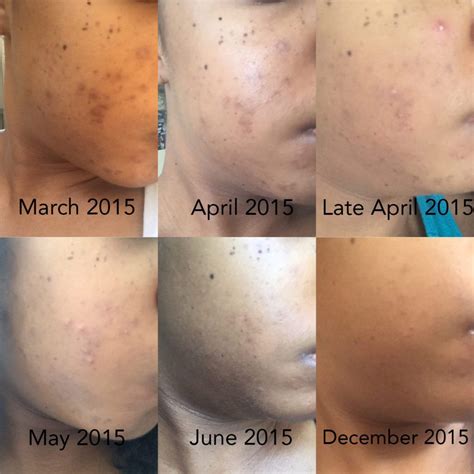 Best Hyperpigmentation Products to Clear Skin Fast - xoNecole