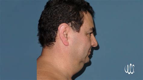 Chin Laser Lipo - Universal Plastic Surgery | Costa Rica