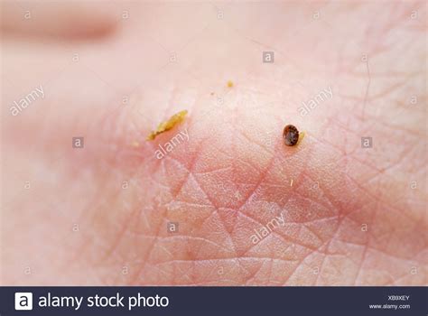 Varroa Destructor Varroa Mite Stock Photos & Varroa Destructor Varroa Mite Stock Images - Alamy