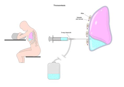 Safe Patient Positioning with the EPD During Thoracentesis