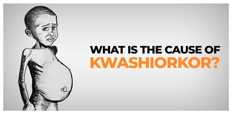 Kwashiorkor