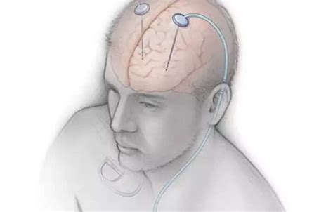 Doctors of Ganga Ram Hospital performs rare surgery for patient suffering from Parkinson, ET ...