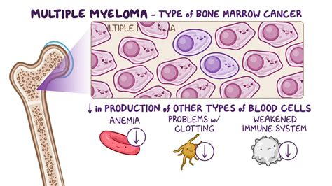 Multiple myeloma: Clinical sciences - Osmosis Video Library