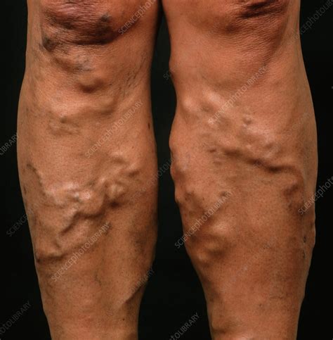 Varicose veins on a woman's legs - Stock Image - M290/0054 - Science Photo Library