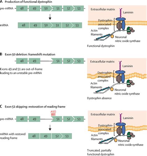 Emerging therapies for Duchenne muscular dystrophy - The Lancet Neurology