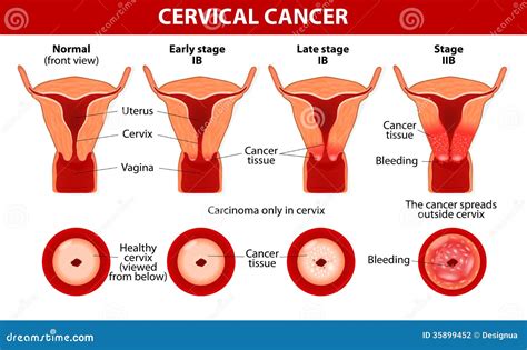 Cervical Cancer. Carcinoma Of Cervix Stock Vector - Image: 35899452