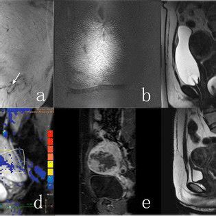 A 41-year-old woman who had a transverse incision scar presented with ...