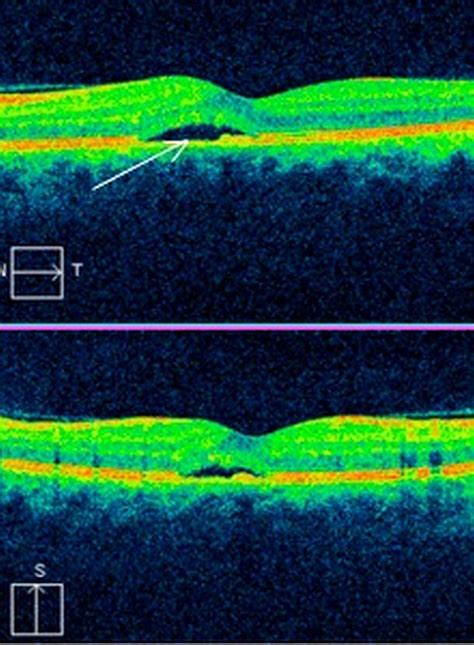 Optical coherence tomography imaging of macular oedema | British Journal of Ophthalmology