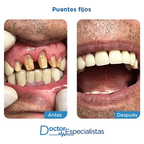 Mejores Clinicas Dentales Para Puentes Fijos | Doctor Especialistas