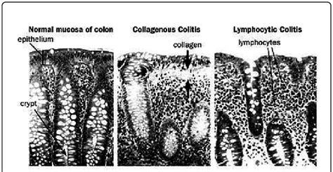 A comparison of histologic features of Collagenous Colitis vs ...