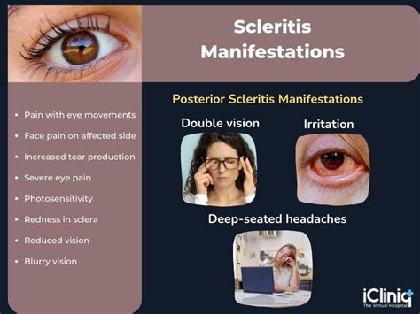 Scleritis - Types | Causes | Diagnosis | Treatment