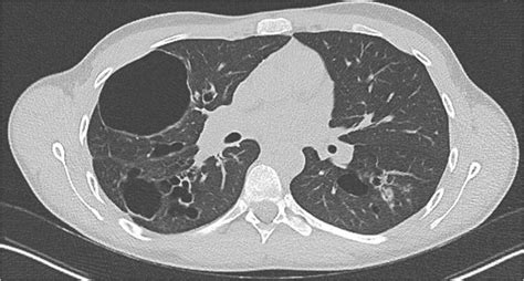 Chest CT showing large pneumatocele and cystic lung changes in an... | Download Scientific Diagram