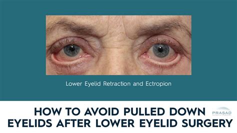 Eyelid Retraction: What It Is, Why It Happens, and How to Avoid It