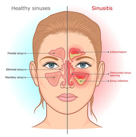 A Sinus Fungal Ball Causes Problems Galore - Suzy Cohen, RPh offers ...