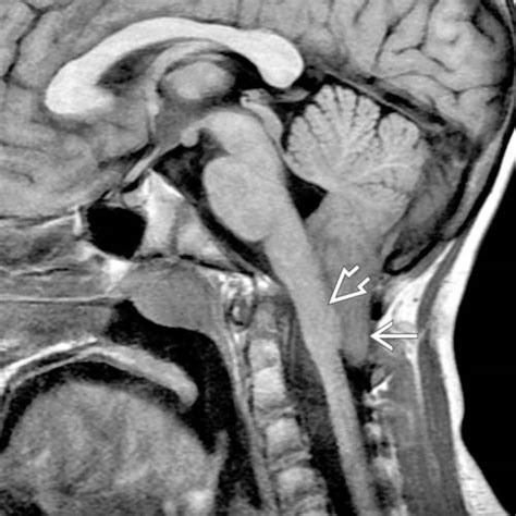 Complex Chiari | Radiology Key