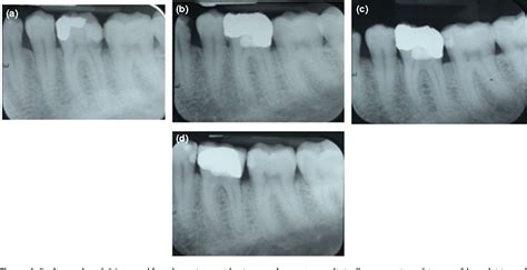 Figure 2 from Assessment of Mineral Trioxide Aggregate pulpotomy in mature permanent teeth with ...