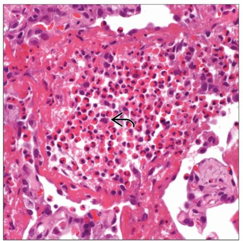 Eosinophilic Pneumonia | Basicmedical Key