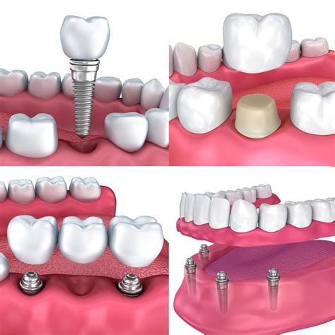 Full Mouth Reconstruction - Orlando, FL - Dental Implants - All-on-4