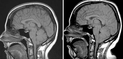 Acute symptomatic cerebellar tonsillar herniation following intraoperative lumbar drainage in ...