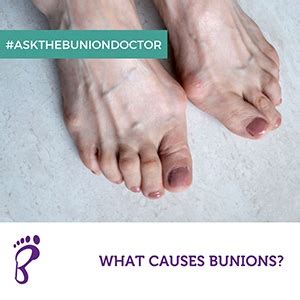 What Causes Bunions? | The Bunion Doctor Hertfordshire