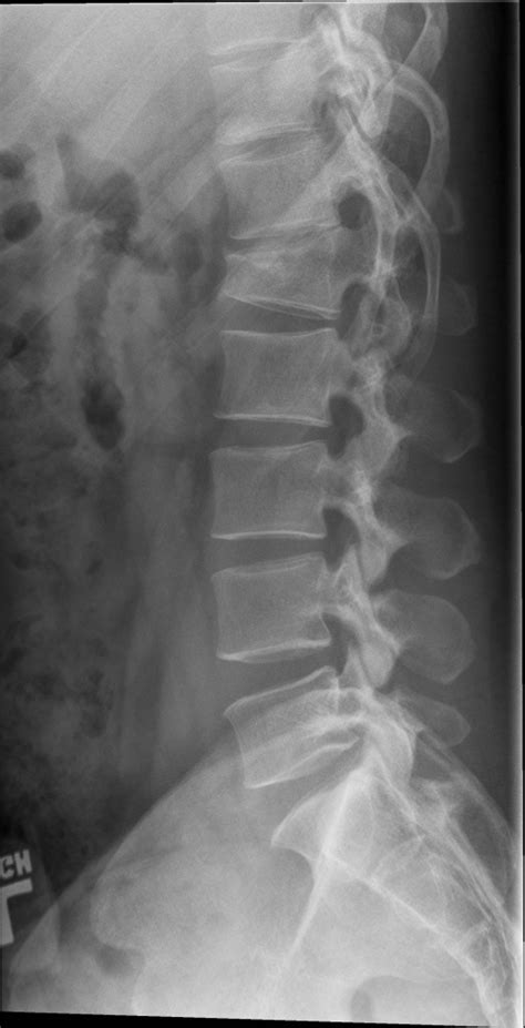 Compression Fracture Lumbar Spine