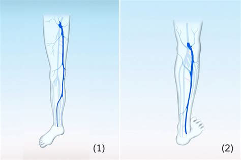 Vein dictionary | Healthy Veins