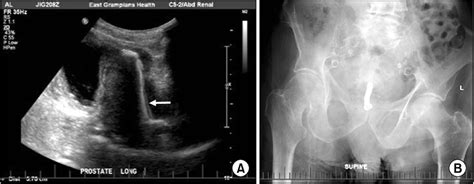 Images of prostatic stent in situ on transabdominal ultrasound (A) and ...