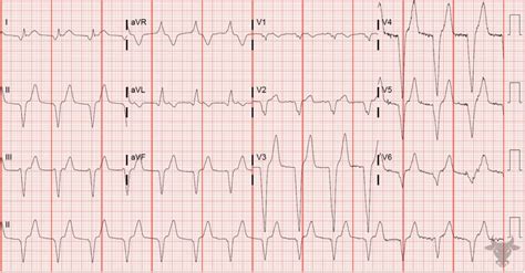 Accelerated Idioventricular Rhythm | ECG Stampede