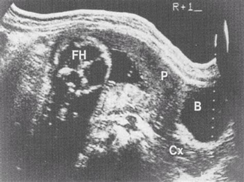 Antepartum hemorrhage