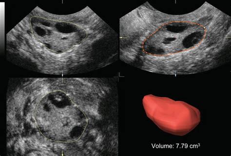 Ultrasound and PCOS | Radiology Key