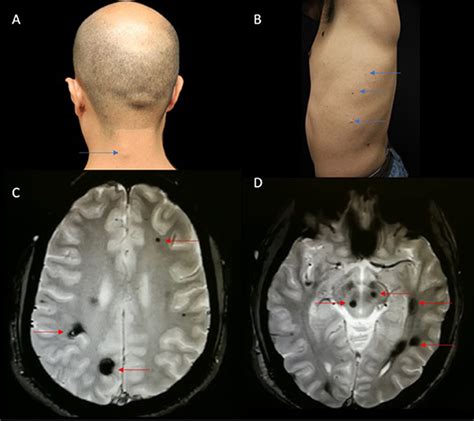 Frontiers | Blue Rubber Bleb Nevus Syndrome With Multiple Cavernoma ...