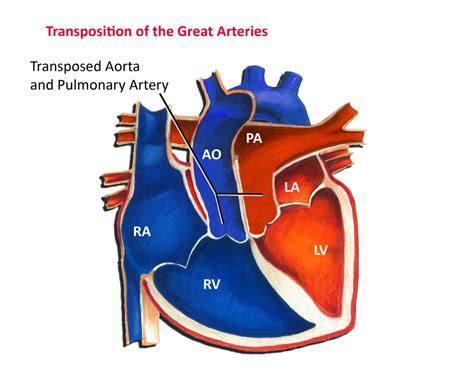 Arterial Switch Operation - Pediatric Cardiology Associates of Houston