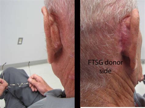 Case Example - Full Thickness Skin Graft | Iowa Head and Neck Protocols