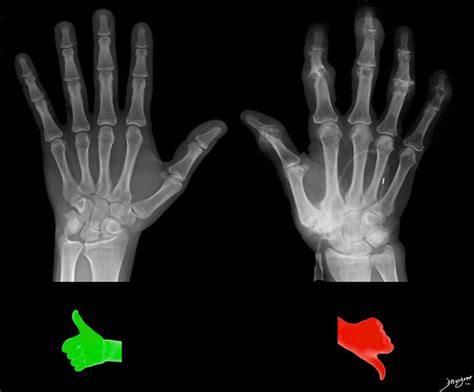 Osteoarthritis | Hands